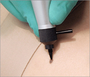 cryoprobe lesion removal